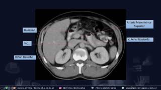 TOMOGRAFIA AXIAL BASICA DE ABDOMEN Y PELVIS [upl. by Ronna]