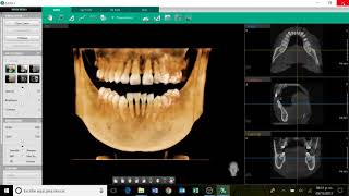 TUTORIAL COMO GRABAR Y ENVIAR TOMOGRAFIA 3D EZ3Di VATECH [upl. by Letney]