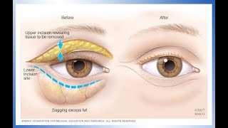 Dr Kristina Tansavatdi  Blepharoplasty PostOperative Instructions [upl. by Trant175]