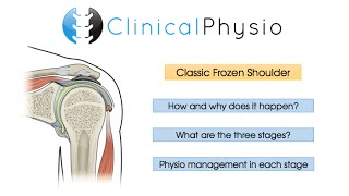 Classic Frozen Shoulder  Clinical Physio [upl. by Silrac]