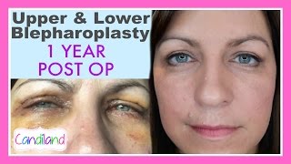 BEFORE amp AFTER BLEPHAROPLASTY SURGERY  1 YEAR POST OP [upl. by Nehpets553]