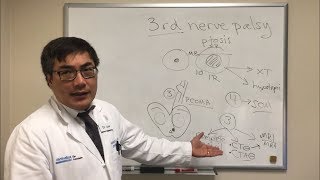 Cranial Nerve 3 CN III Palsy [upl. by Notsua79]