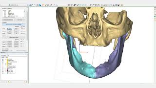 Mandible Reconstruction Tutorial  PROPLAN CMF™ [upl. by Chenay]