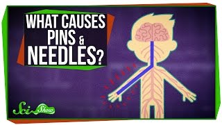 What Causes Pins and Needles [upl. by Mun903]