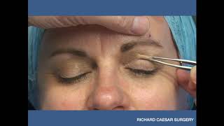 Upper Eyelid Surgery in Dallas by Dr Michael Bogdan [upl. by Borras]