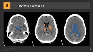 Cómo describir una TC de Cerebro [upl. by Notsuoh]