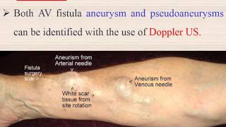 fistula Arteriovenous fistula AVF for Hemodialysis patients [upl. by Ecirtel928]