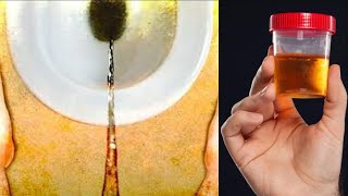 4 Reasons Why Your Urine is Dark in Color [upl. by Retsae]