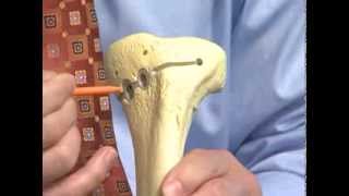 Osteoid Osteoma Bone Pathology Basics [upl. by Dustin]