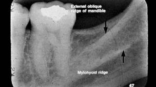 Dental Radiographic Anatomy [upl. by Seuqirdor]