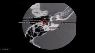 TOMOGRAFIA COMPUTADA DE OIDO PEÑASCO Y CONDUCTO AUDITIVO [upl. by Munafo]