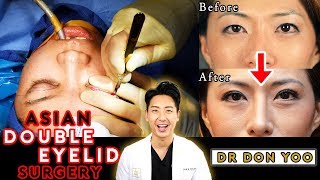 My Blepharoplasty Before and After [upl. by Nwahsav52]